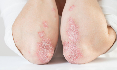 Más allá de la piel: lo que el Día Mundial de la Psoriasis nos invita a ver