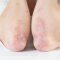 Más allá de la piel: lo que el Día Mundial de la Psoriasis nos invita a ver